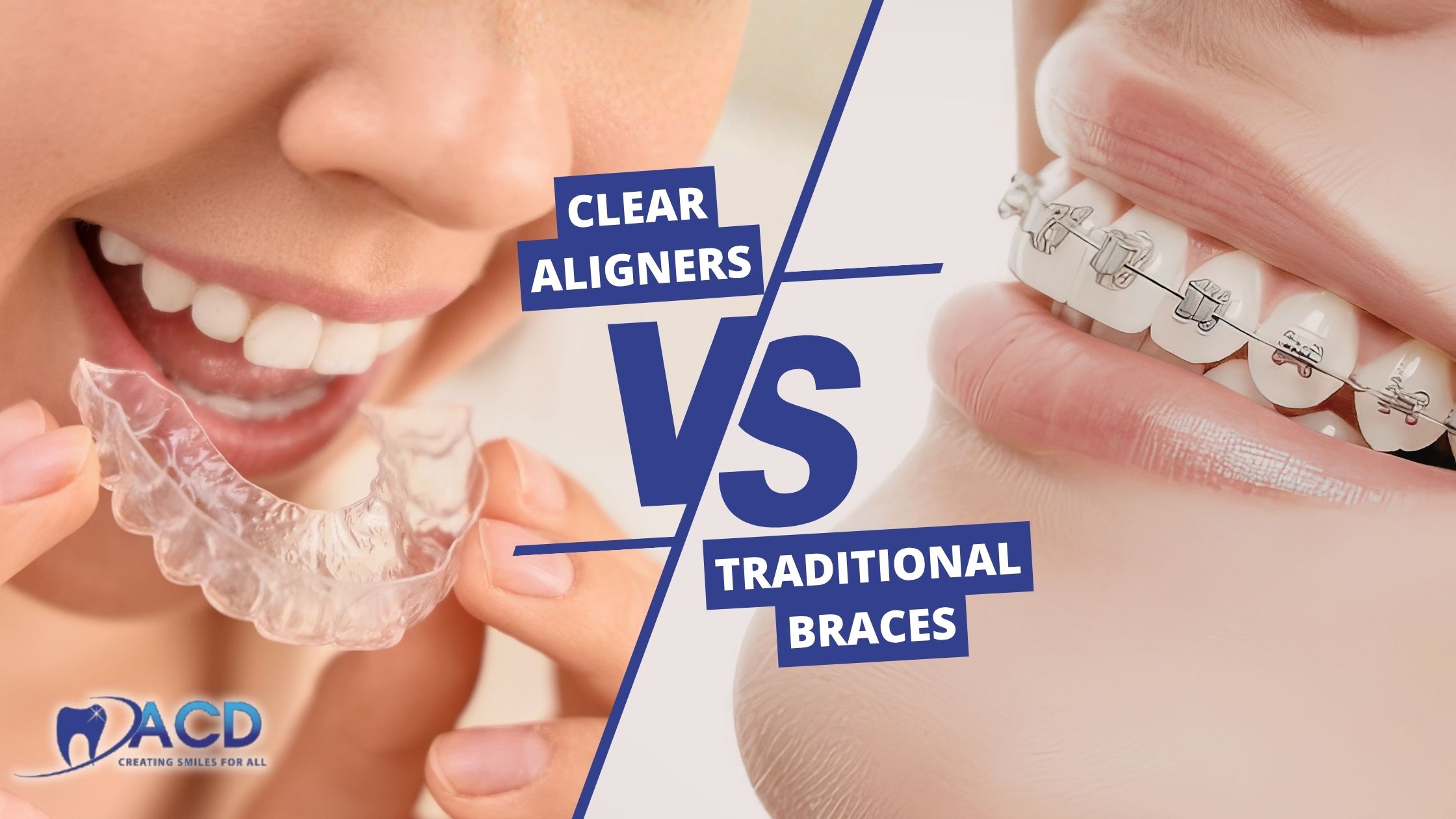 Clear Aligners vs Braces for Adults in Whitehall PA: Cost, Comfort & Results